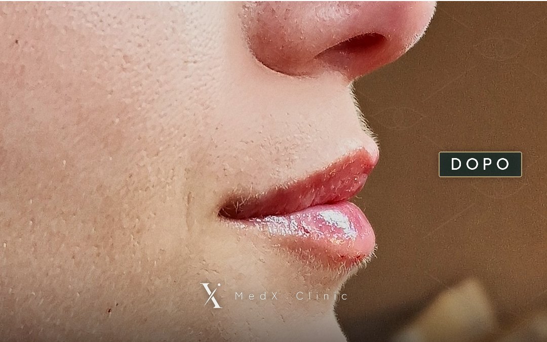 Labbra di una paziente, di profilo, subito dopo