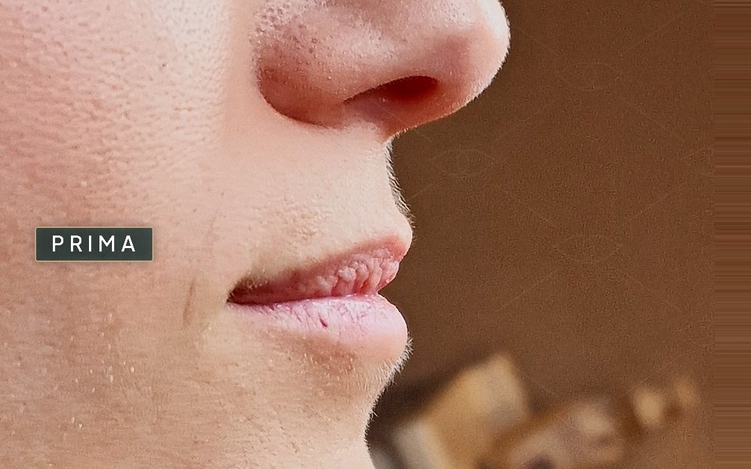 Labbra di una paziente, di profilo, prima